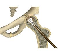 Core Decompression for Avascular Necrosis of the Hip 