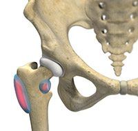 Hip Bursitis