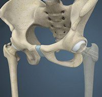 Hip Fractures