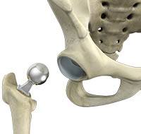 Hip Hemiarthroplasty