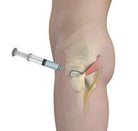 Hip Injections