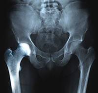 Hip Osteoporosis