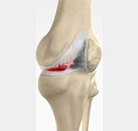 Knee Arthritis