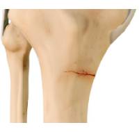 Knee Fracture Surgery