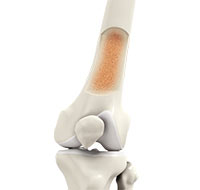 Knee Osteoporosis