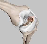 Meniscal Injuries