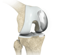 Partial Knee Replacement