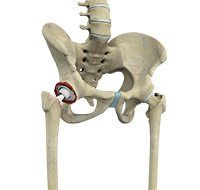 Revision Hip Replacement